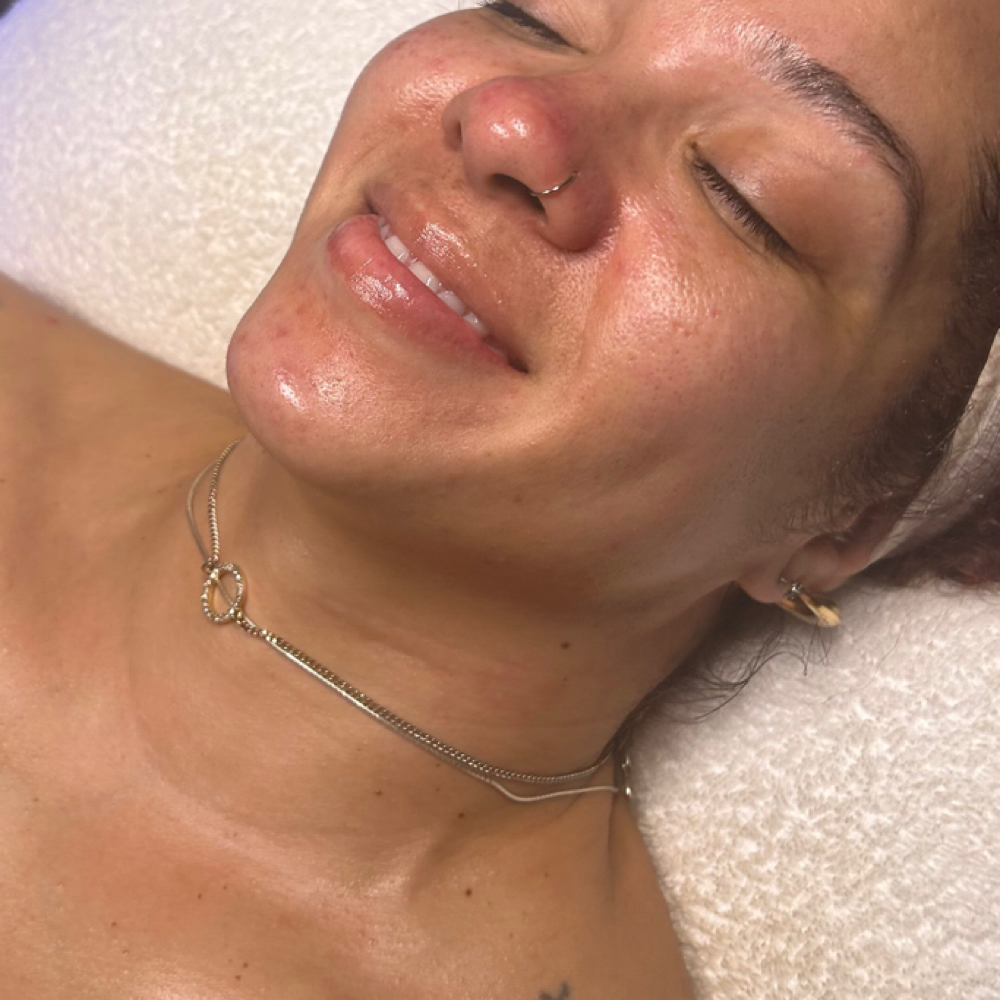 Glow Peel (3-6 Sessions Recomm.) at Beauty Therapy by Chanel in Tucker, GA