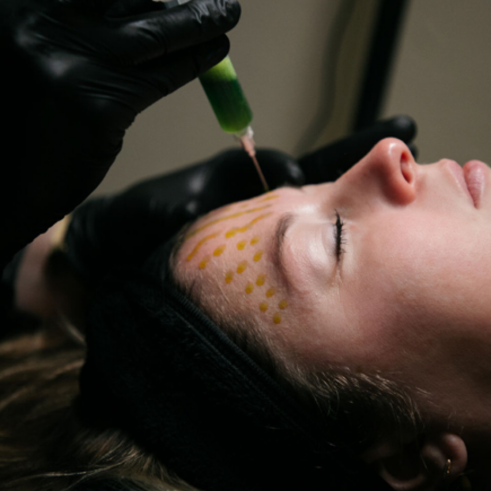 BioRePeel at Reese SkinTreat in Cape Girardeau, MO
