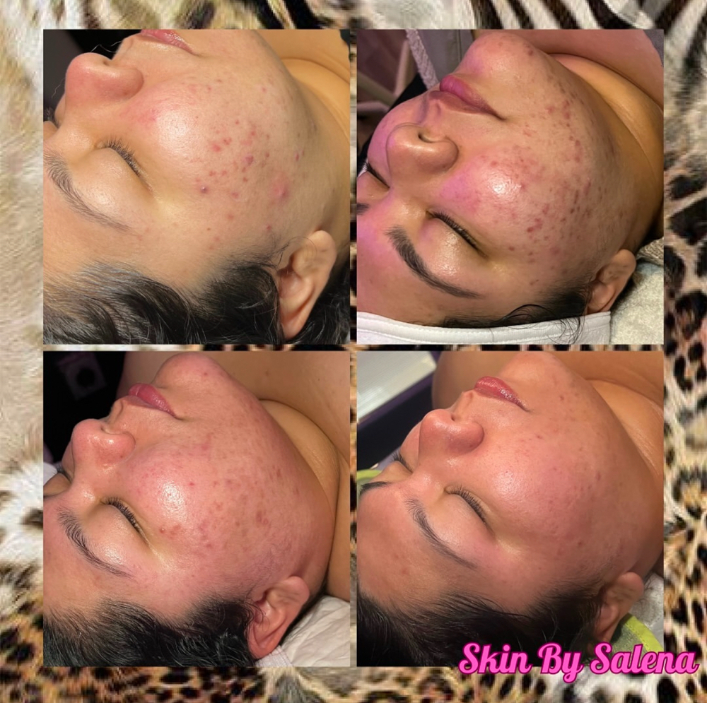 Face Reality Acne Treatment