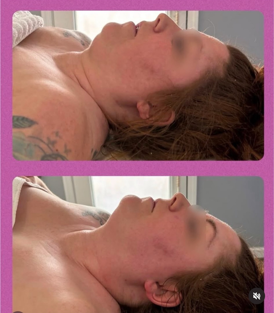 Brazilian Lymphatic Facial