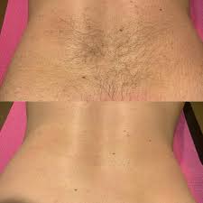 Waxing - Upper/Lower Back