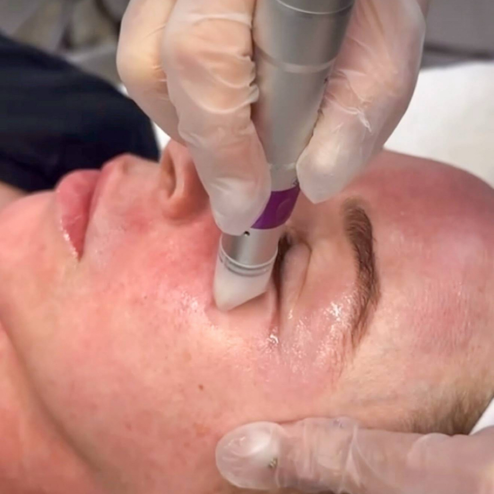 Microneedle Vitamins C & Peptides at Forever Young By Andrea in Deer Park, NY