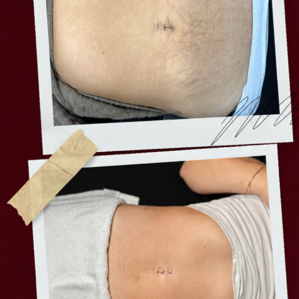 Milfneedle-Stretch Marks at Indigenous Beauty in Provo, UT