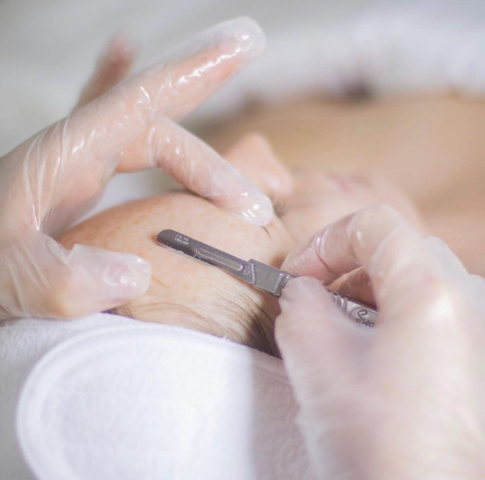 Dermaplaning