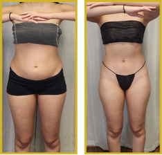 Fast Fat Reduction (recmd 10)