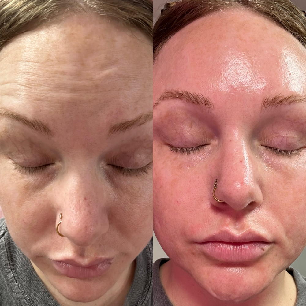 Carboxy Facial