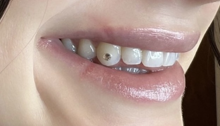 Single Tooth Gem