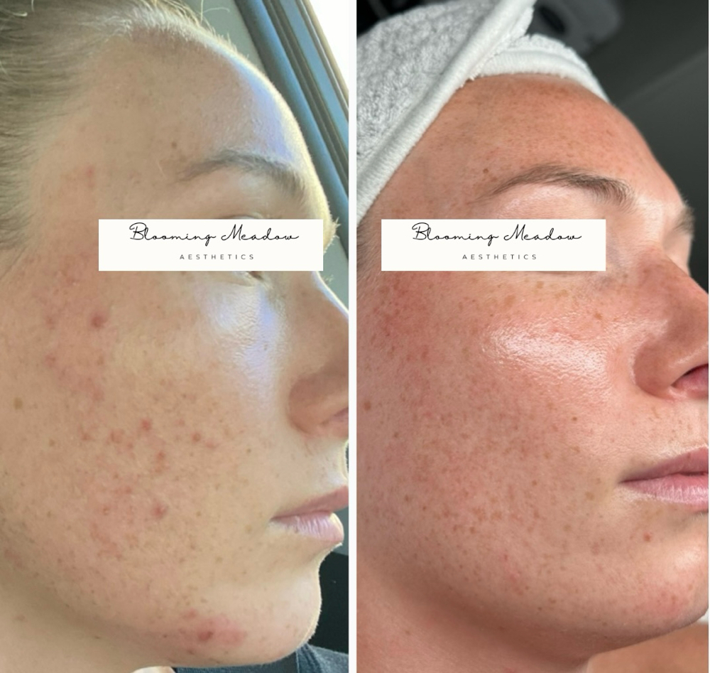 Acne Bootcamp Chemical Peel
