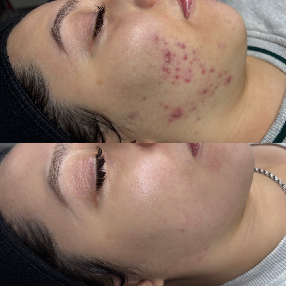 Liquid Microneedling Add-On