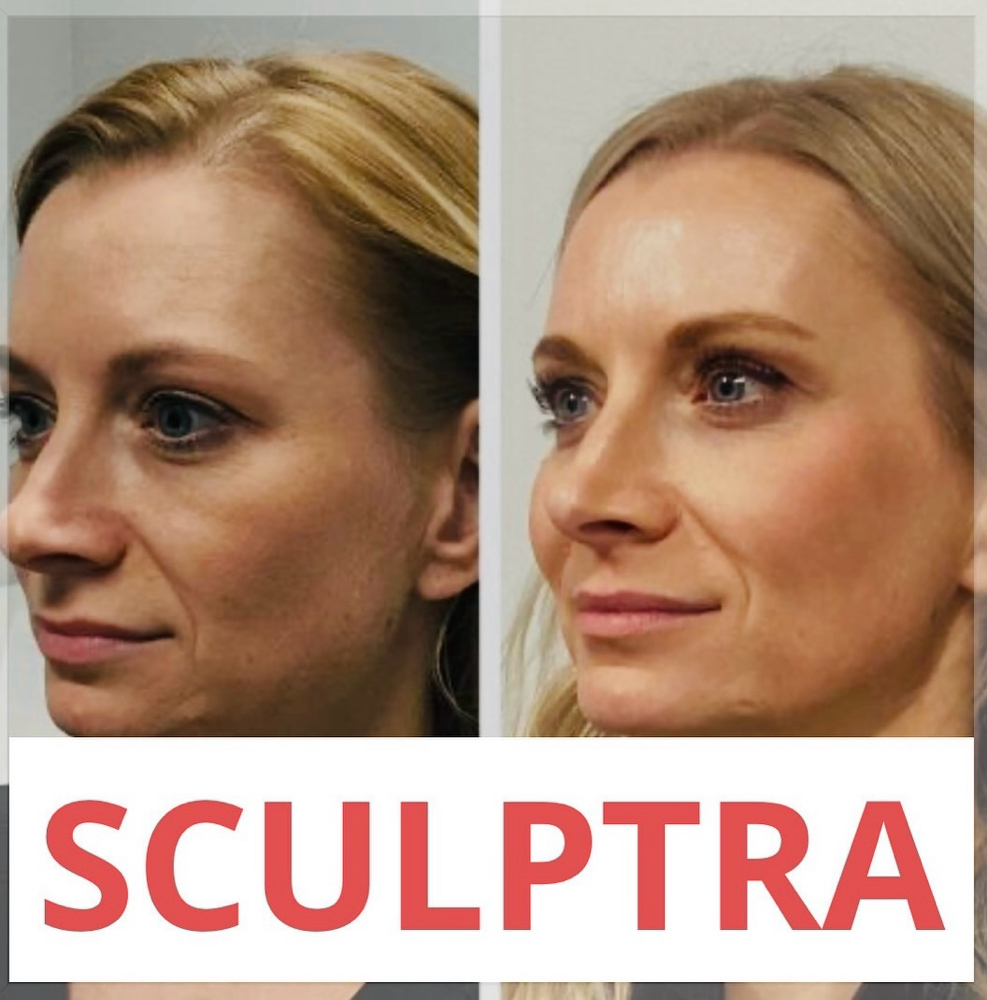 Sculptra & PRP/ Sculptra y Plasma