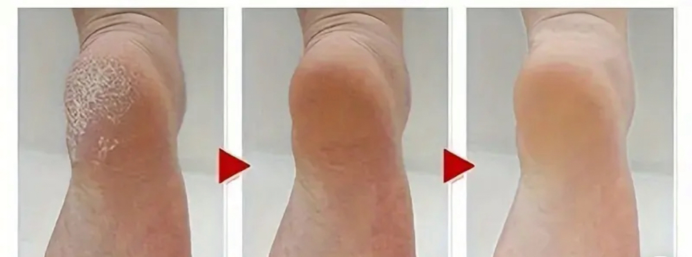 Callus treatment