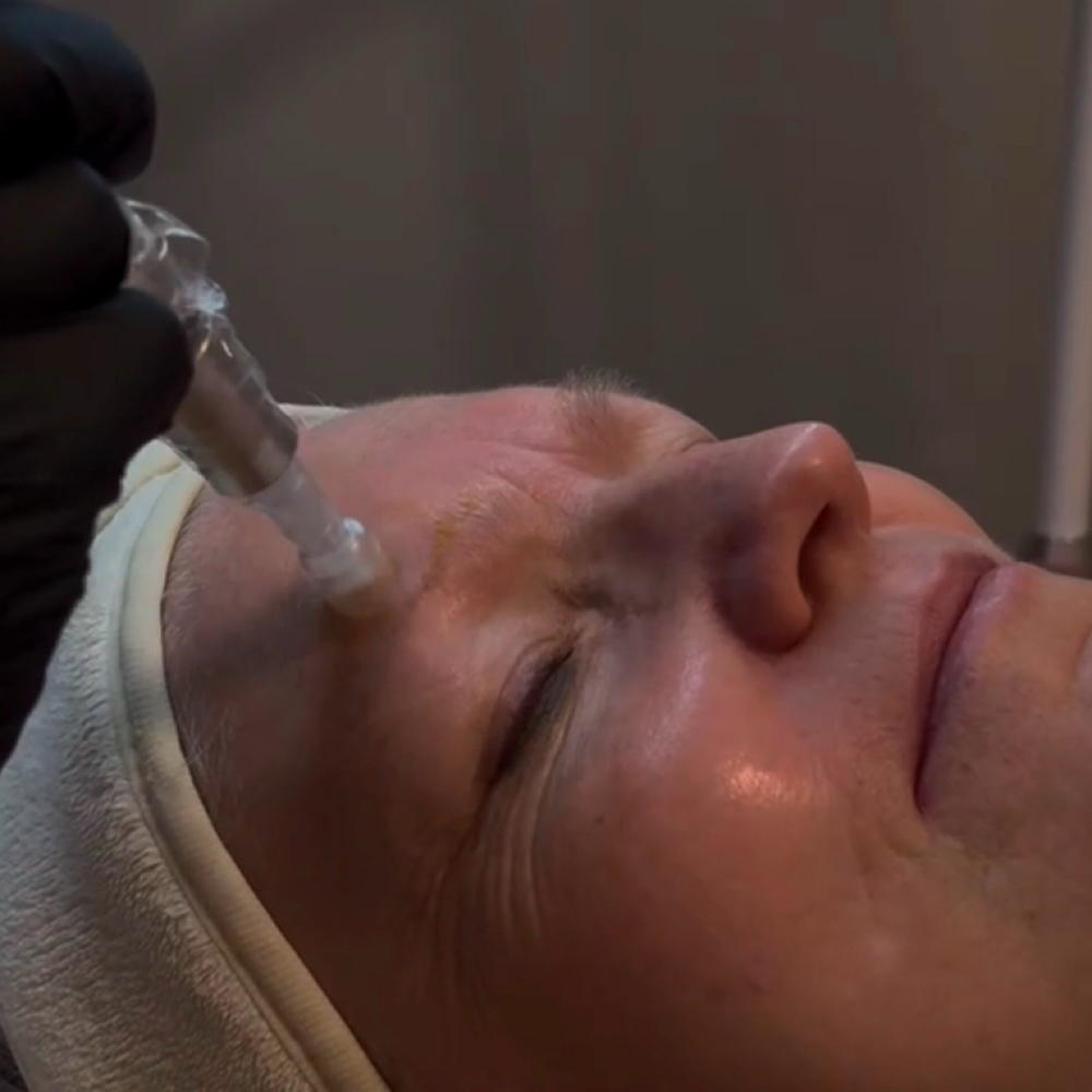 Microneedling With Sera Mesotherapy at Skin & Syringe Aesthetics in Rockwall, TX