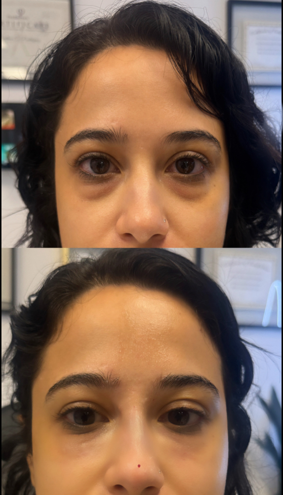 Under Eye Filler
