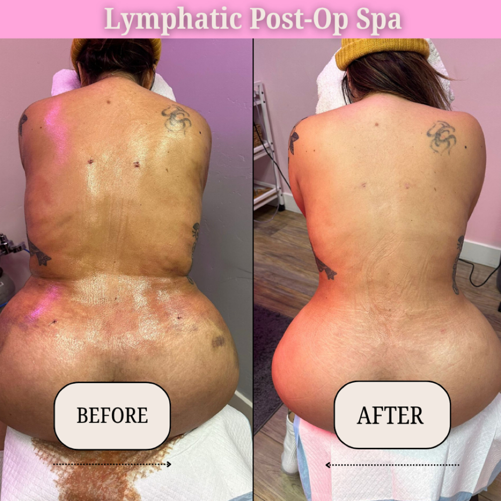 Post-Op Lymphatic Drainage Massage at Lymphatic Post-Op Spa in San Diego, CA