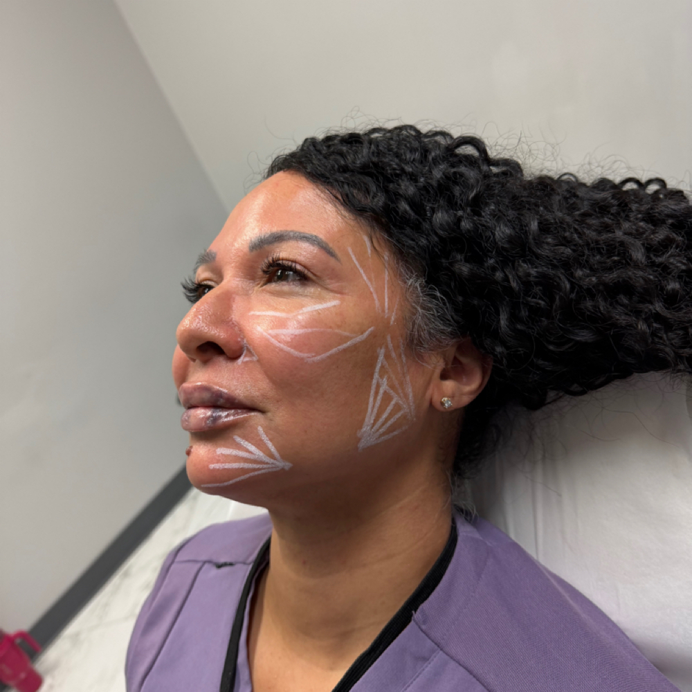 Cheek Fillers at Atelier Aesthetics and Infusions in Dallas, TX