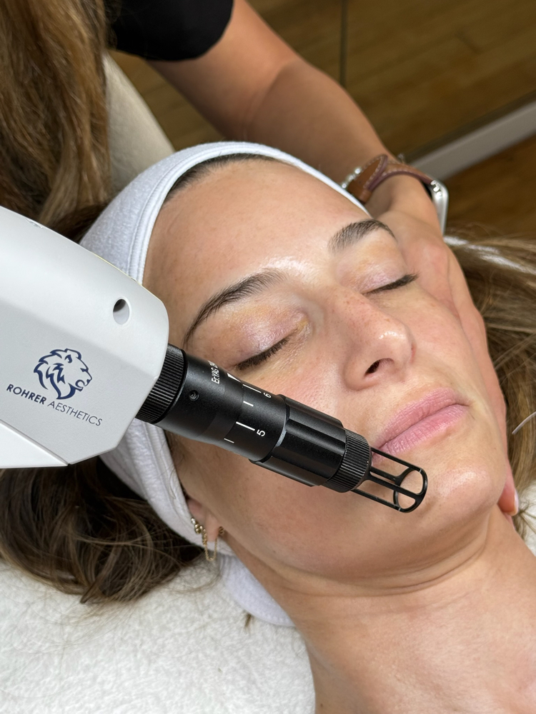 Erbium Skin Resurfacing