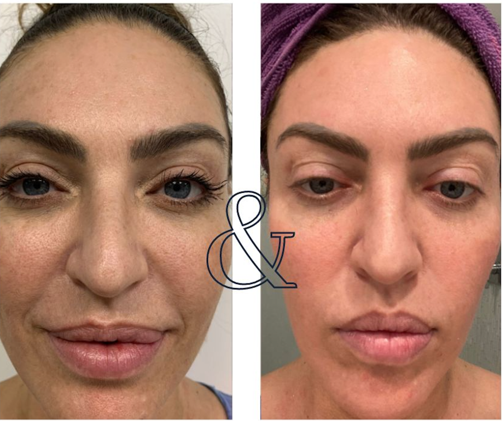 Erbium Skin Resurfacing