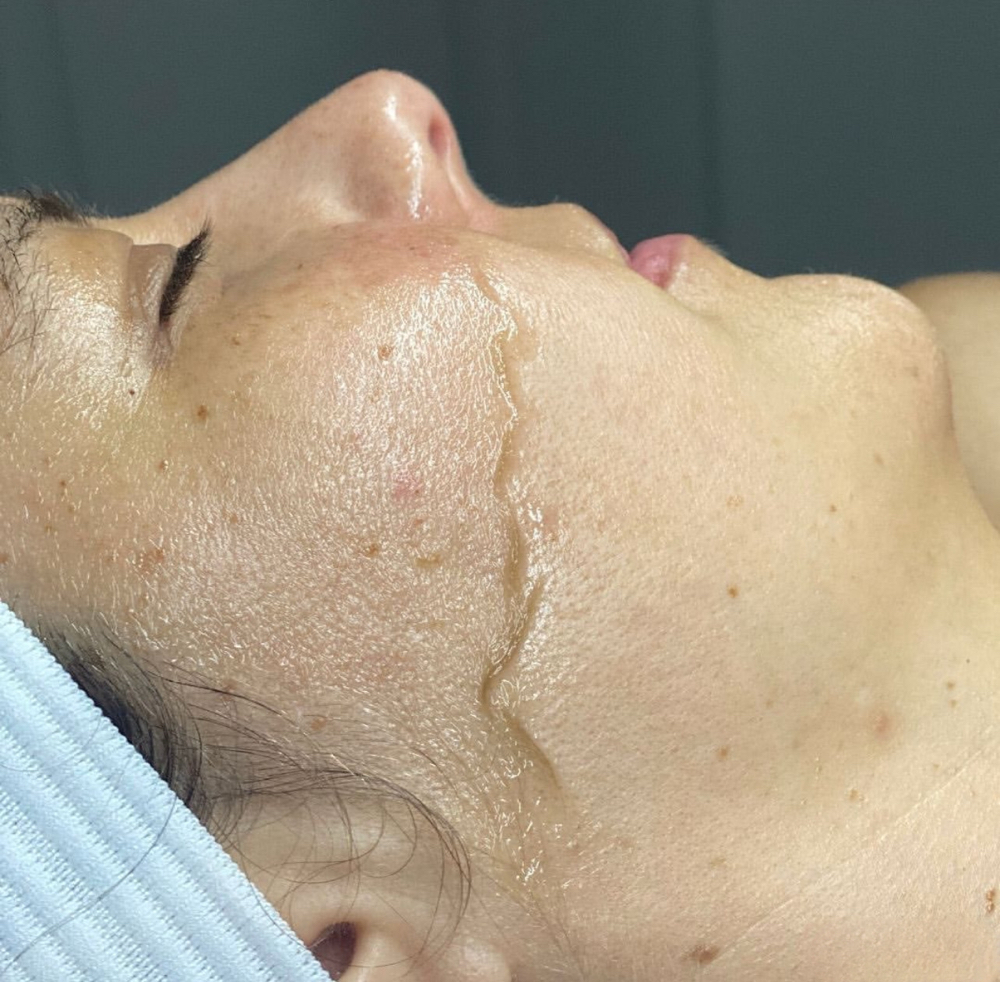 Peach Fuzz Roundup - Dermaplane