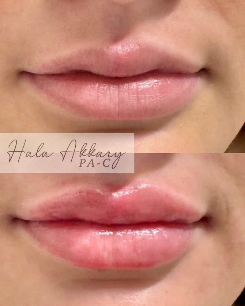 Lip Filler Special (1/2 Syringe)