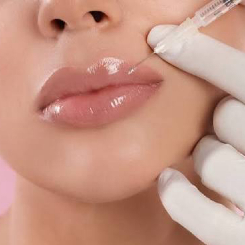 Lip Filler  (1/2 Syringe)
