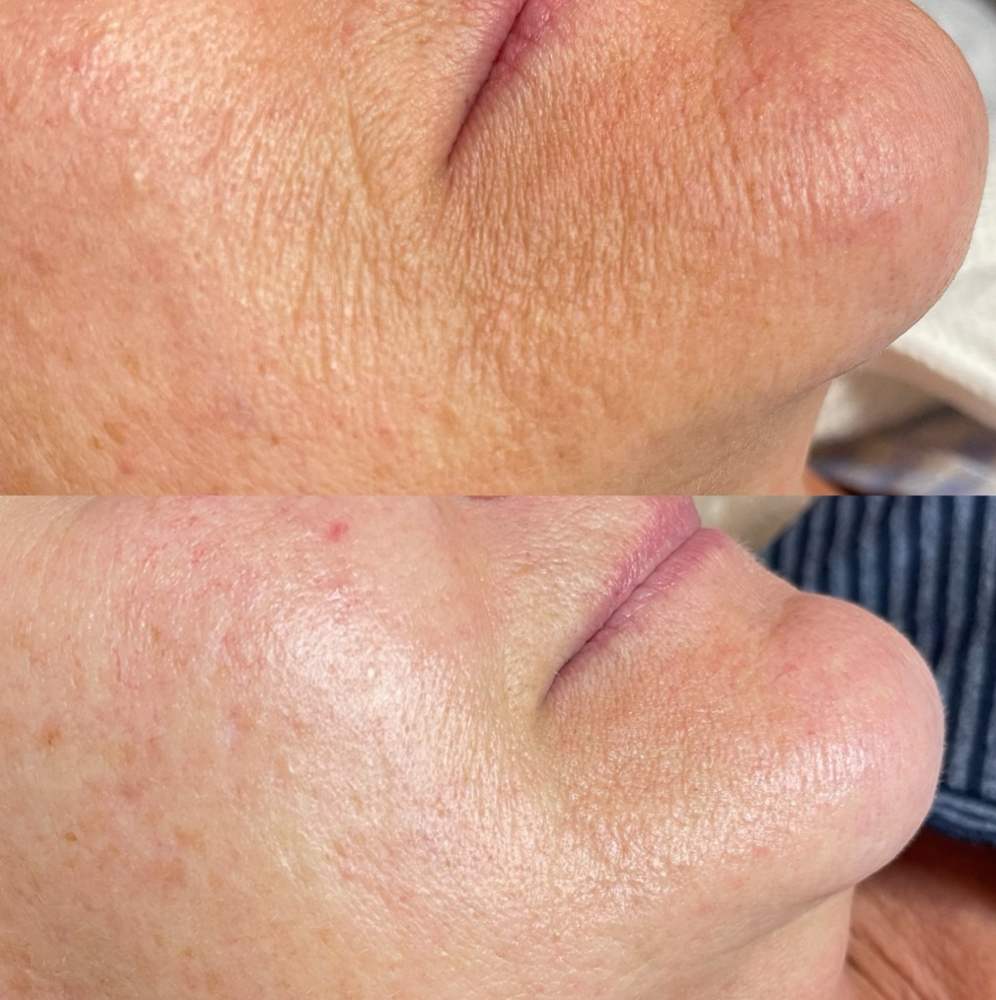 Procell - Collagen Therapy at Glow Esthetics in Eagan, MN
