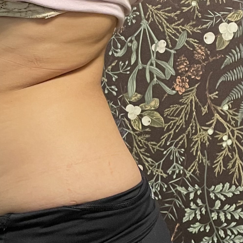 Bra Bulge Fat Dissolve
