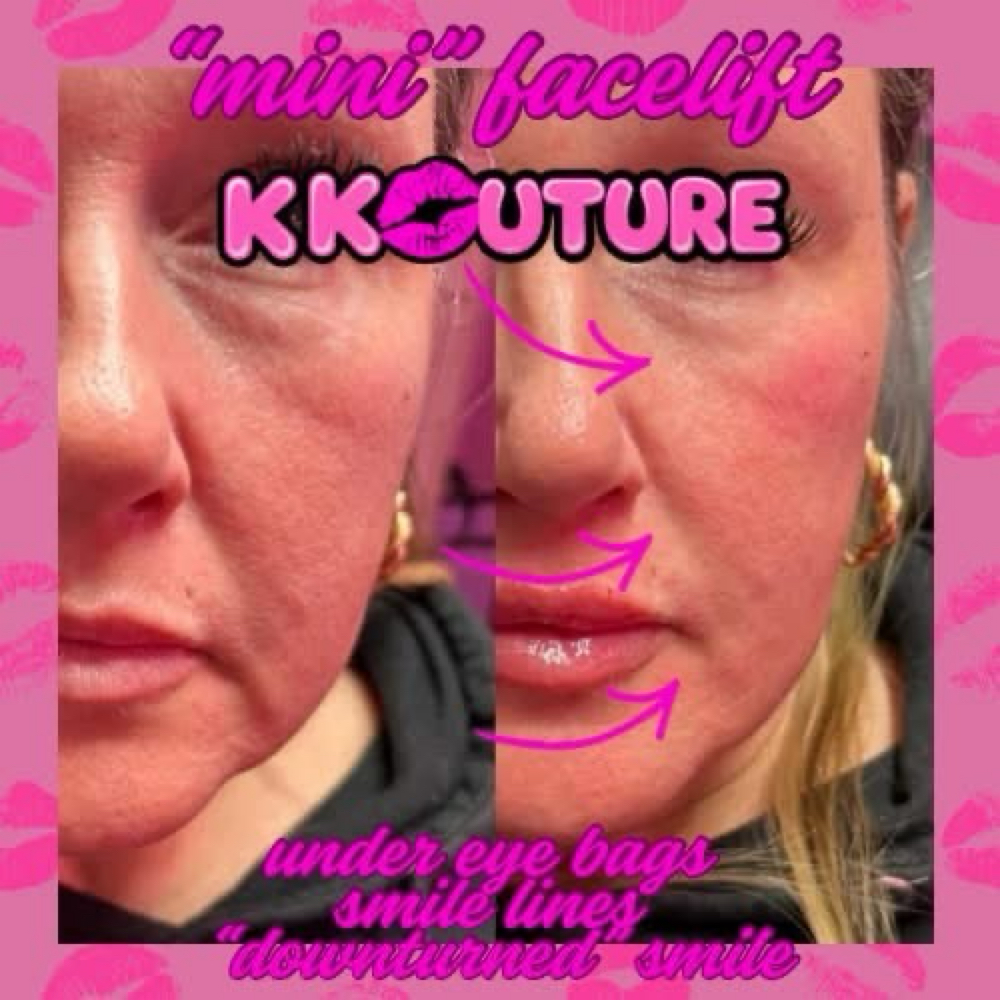 Chin, Cheek & Lips at k kouture in Fort Worth, TX