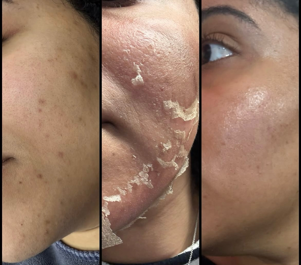 🧪 Chemical Peel (Per Session)