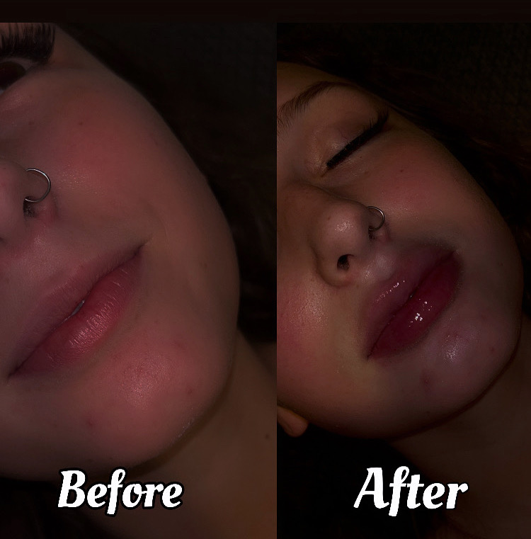 LIP FILLER