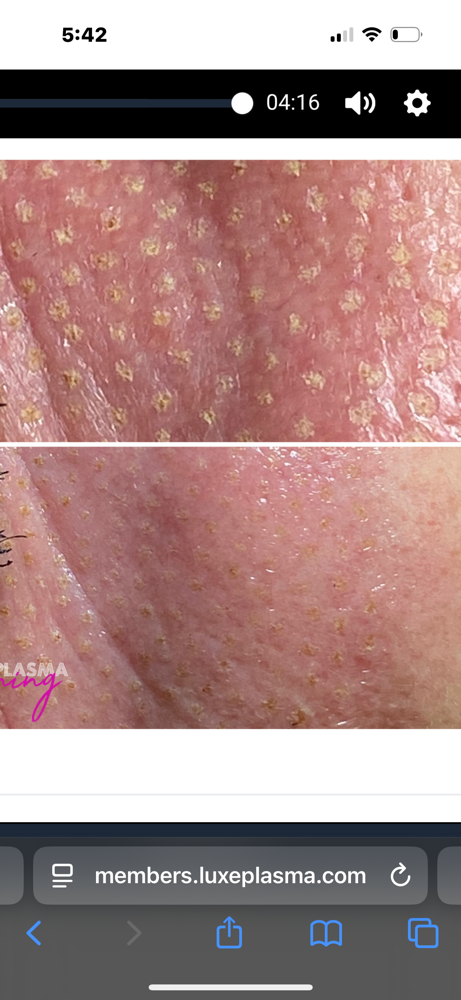 Plasma Lifting Consultation