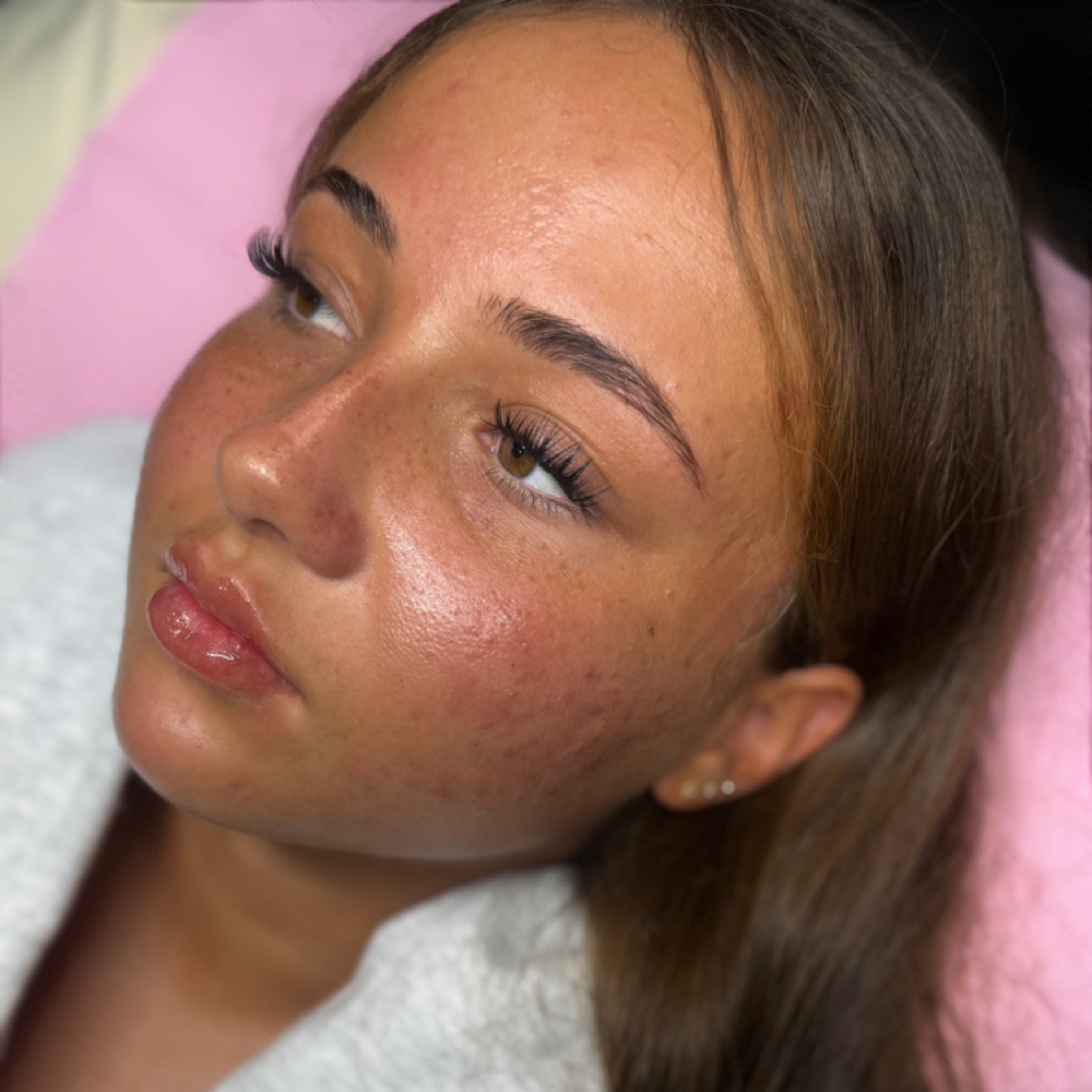Lip + Nose Filler at Maurika Beauty in Jacksonville, FL
