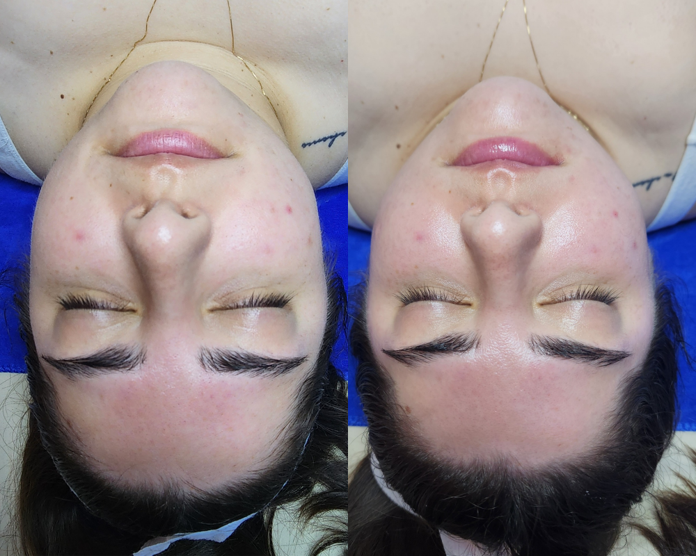 Oxygen Infusion Facial