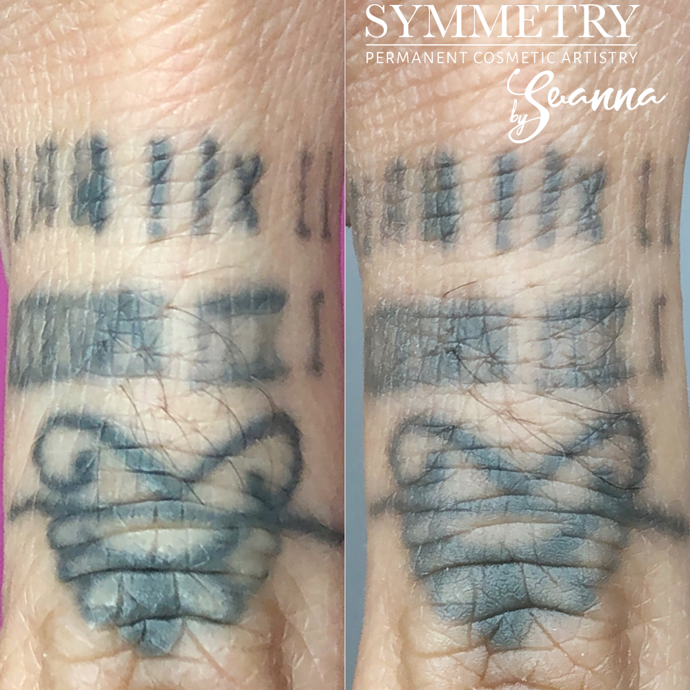 Saline Tattoo Lightening/Removal