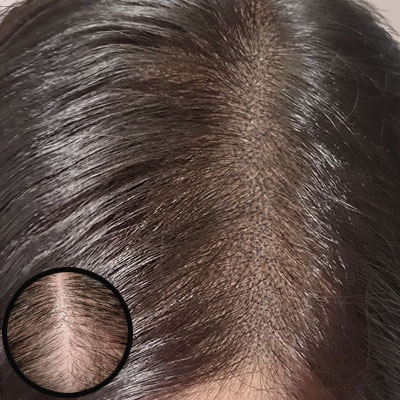 Hairline Restoration SMP