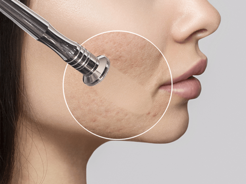 Microdermabrasion Radiance