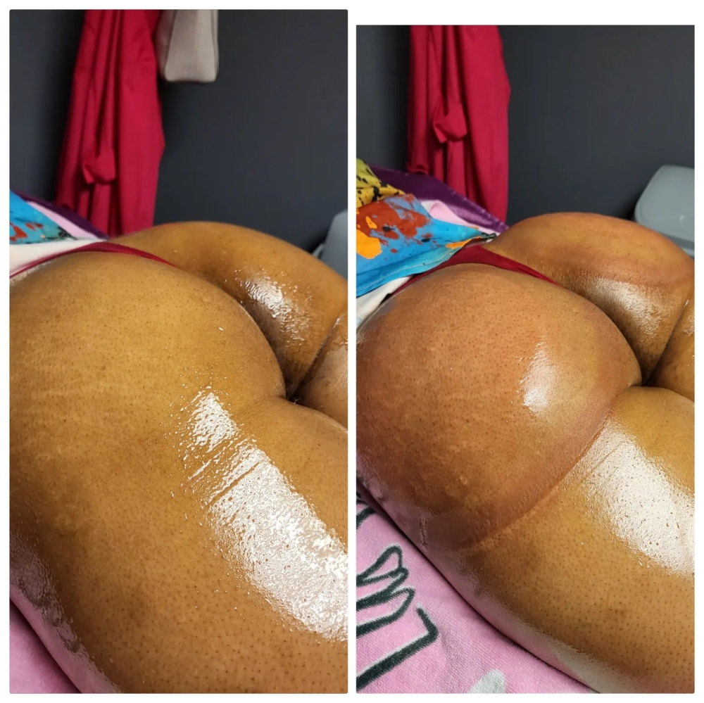 Non Invasive BBL / Perfect PEACH 🍑