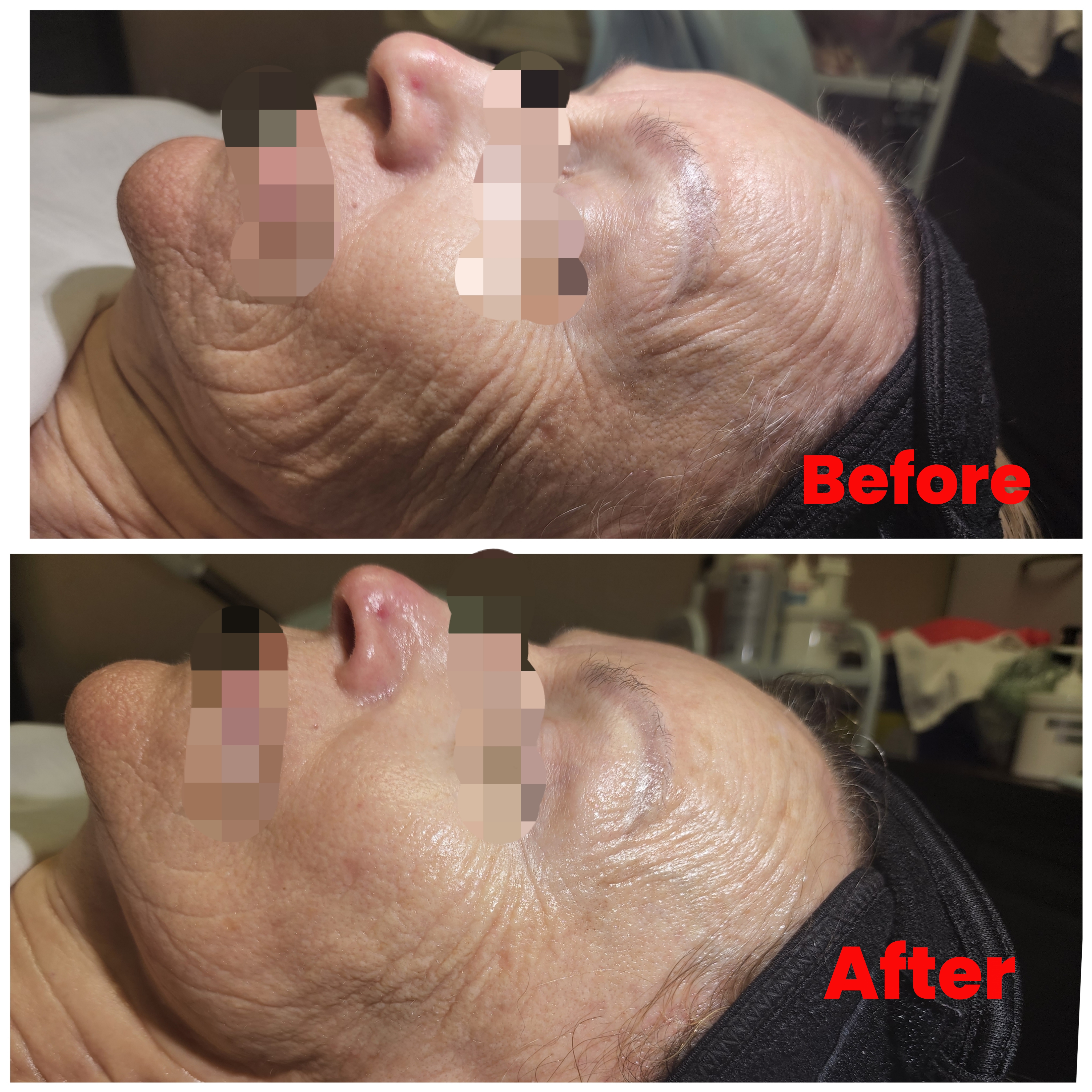 Mini Botox Facial (non invasive)