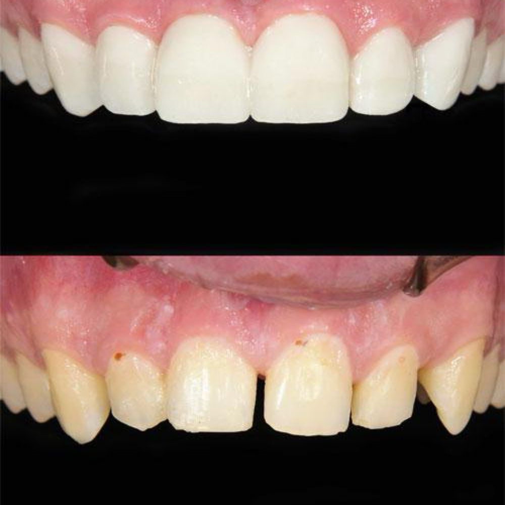Composite Veneers Removal at BG Cosmetic in Inglewood, CA
