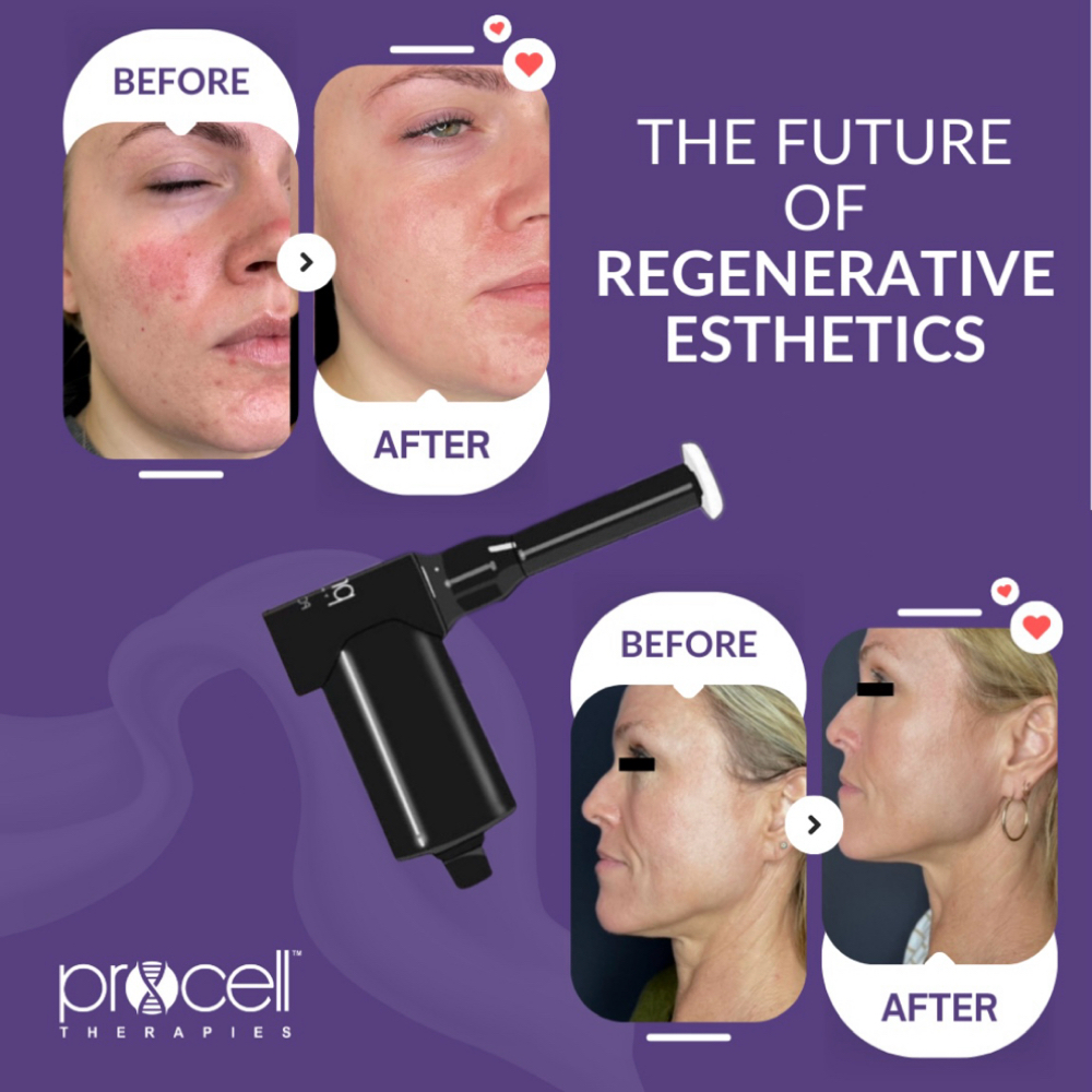 Procell Therapy at Glowing Aesthetics in Yorkville, IL