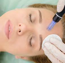 Microneedling