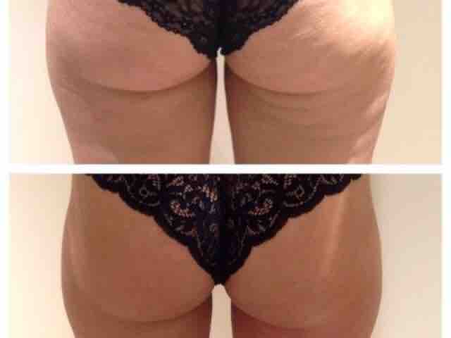 CryoTone