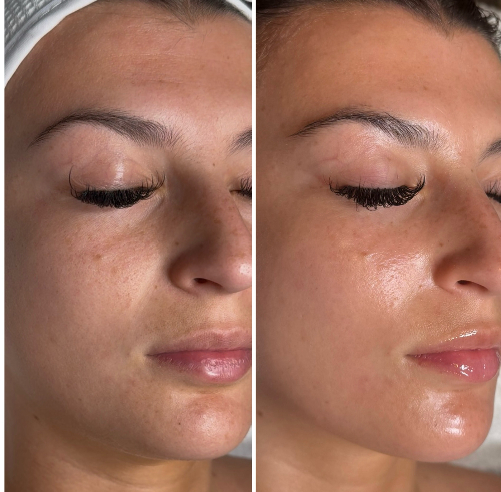Dermaplanning Facial + Peel