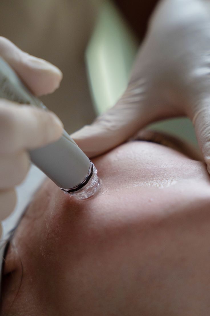 Hydrodermabrasion
