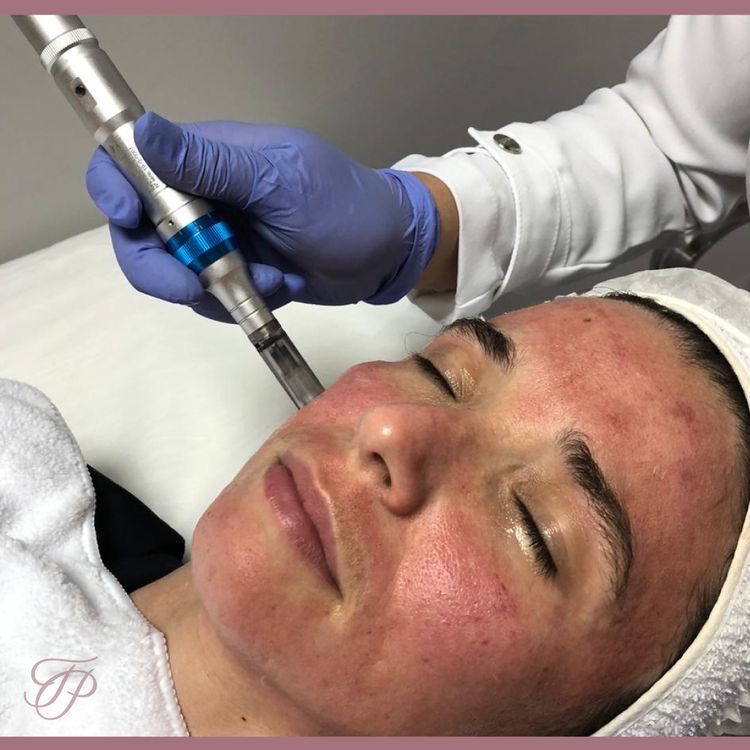 Facial Training - Microneedlig