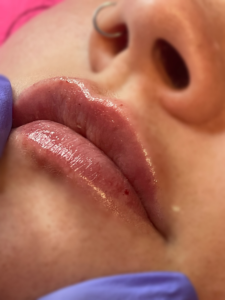 Lip Filler 1ml