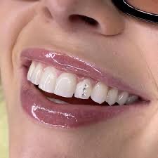 Teeth Whitening Touch Up