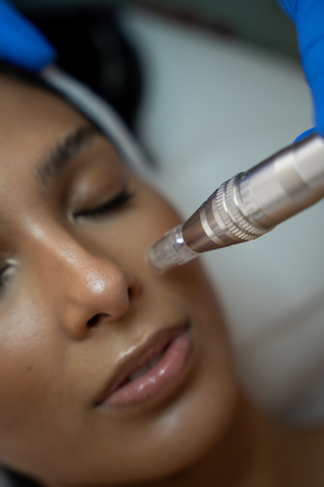 Microneedling