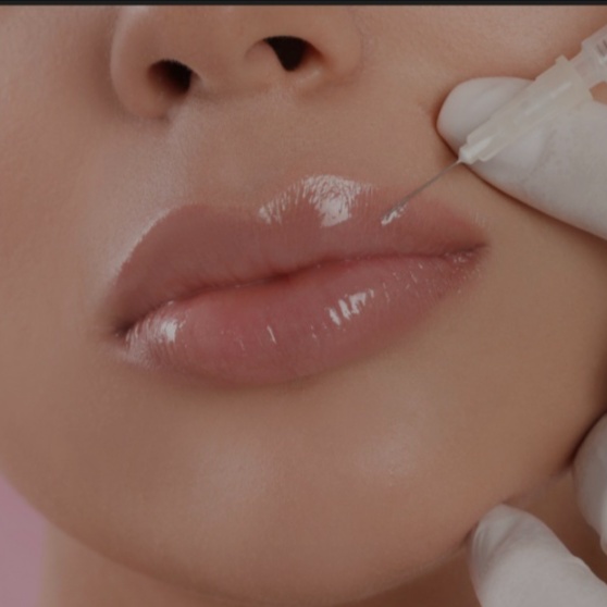 1 SYRINGE LIP FILLER at Remake Beauty Studio San Juan in San Juan, TX