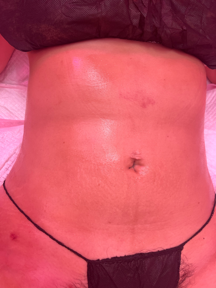 Lymphatic Massage + Cavitation