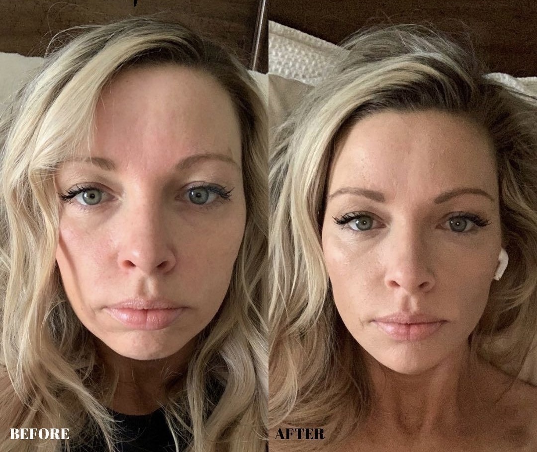 Chin Lift